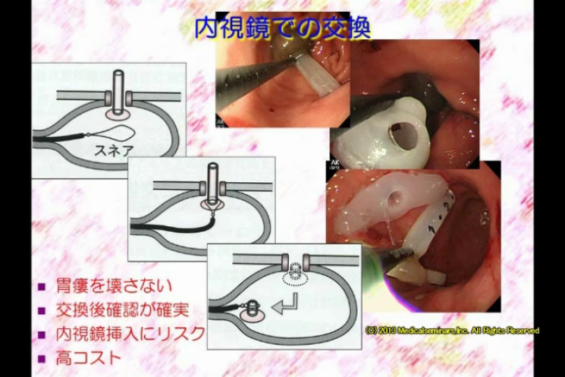 胃瘻のトラブル対策(2)胃ろうの交換は怖い vol.2